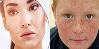 اختلال رنگدانه های پوست و درمان آن