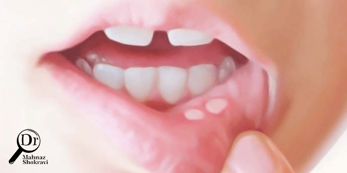 آفت دهان چیست؟ علت و درمان آن کدام است؟