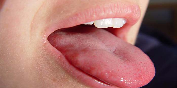 علت التهاب زبان(گلوسیت) چیست و چگونه درمان می شود؟