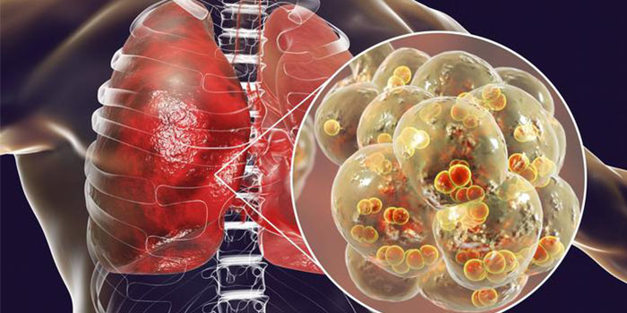 بیماری فیبروز ریوی چیست چه علت، علائم و درمانی دارد؟