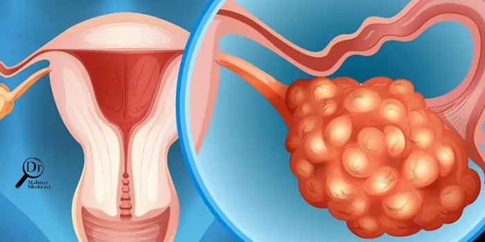 سرطان تخمدان و روش های درمان آن
