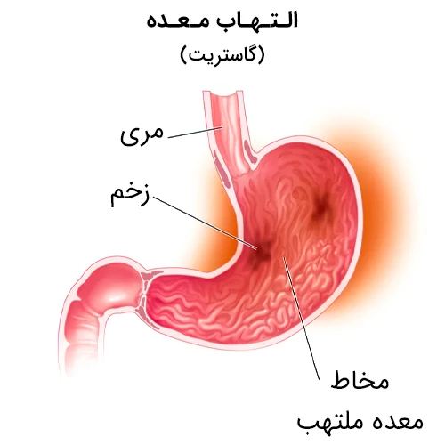 ورم معده -مهناز شکروی