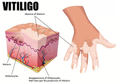 بیماری ویتیلیگو یا برص-دکتر مهناز شکروی