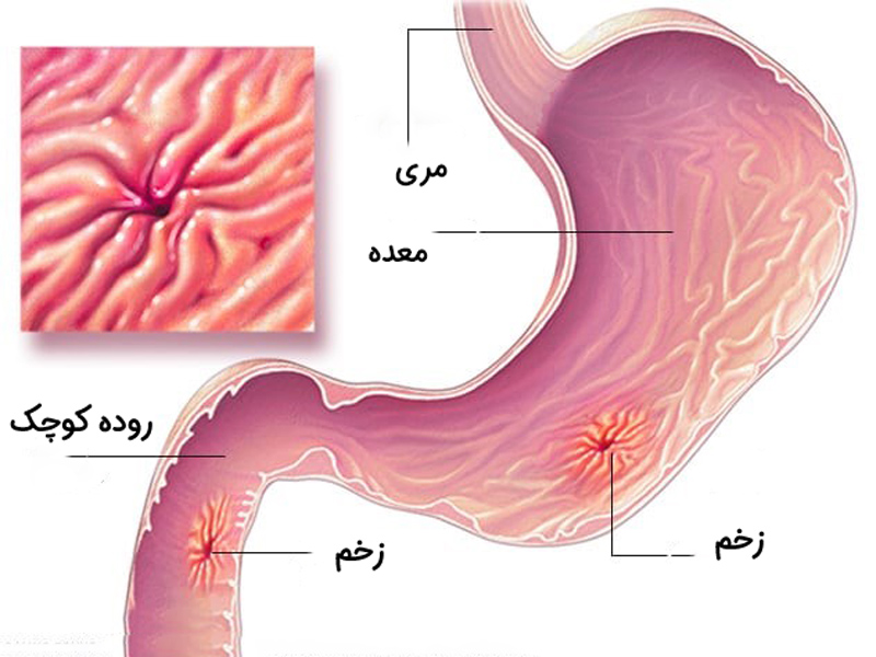 زخم مری - دکتر مهناز شکروی