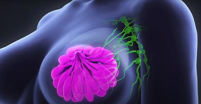 سرطان سینه - دکتر مهناز شکروی