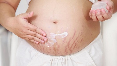 ترک های پوستی در بارداری-مهناز شکروی